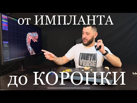 Видео: От импланта до коронки! Зачем нужны сканмаркеры, основания, абатменты и трансфера с аналогами?!