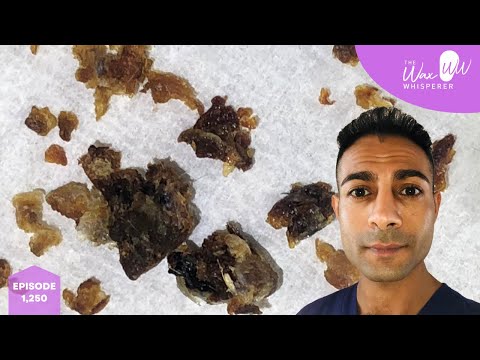 Видео: 1250 — удаление ушной серы, вызывающей сильный зуд и царапание