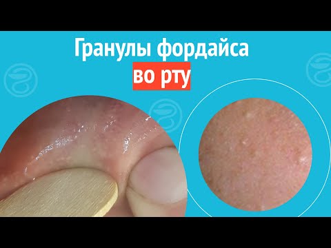 Видео: 😢 Гранулы фордайса во рту. Клинический случай №1674