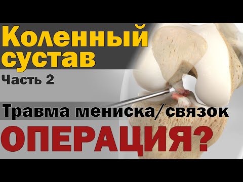 Видео: Делать ли пластику связок / мениска коленного сустава? [S05E13]