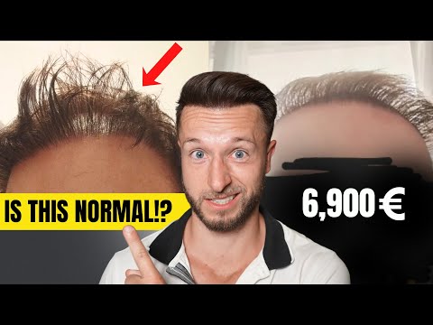 Видео: Его пересадка волос не удалась!?