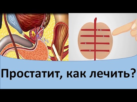 Видео: Простатит как лечить? Простатит лечение.