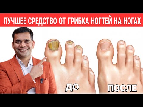 Видео: Лучшее Средство От Грибка Ногтей На Ногах | Доктор Вивек