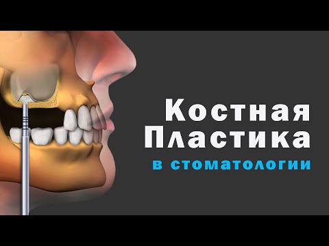 Видео: Виды костной пластика в стоматологии. После костной пластики