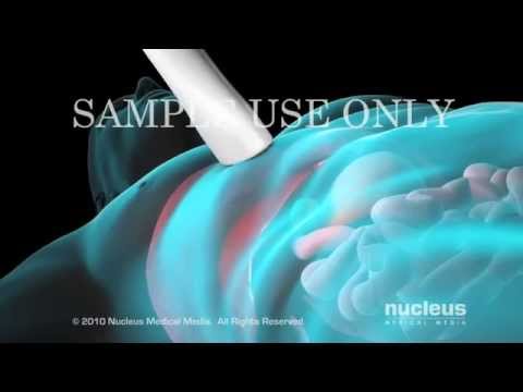 Видео: Биопсия печени Перевод