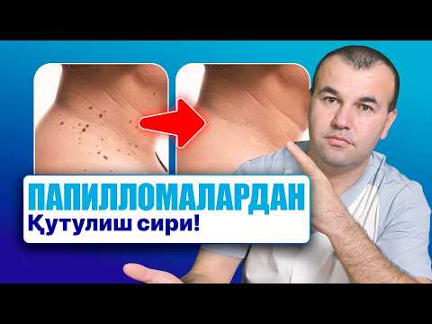 Видео: Папилломадан қандай қутулиш мумкин? Дерматолог тушунтиради