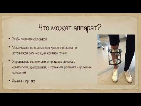 Видео: 2.25. Применение компрессионно-дистракционных аппаратов в ортопедии.