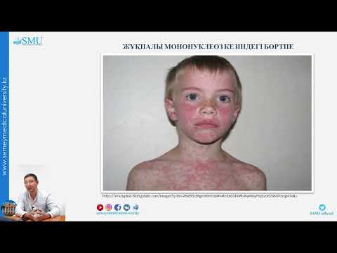 Видео: балалардағы жұқпалы мононуклеоз