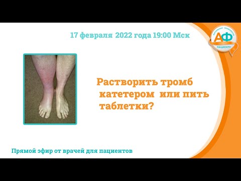 Видео: Растворить тромб катетером или пить таблетки?