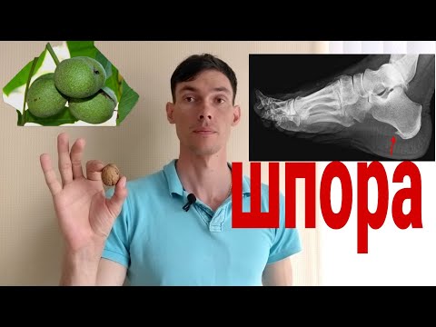 Видео: Пяточная ШПОРА убрать легко