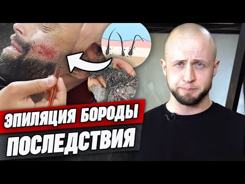 Видео: Нельзя вырывать волосы на бороде таким способом! / Какую эпиляцию волос на бороде выбрать?