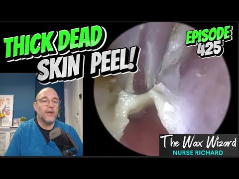 Видео: Отшелушивание толстой омертвевшей кожи! Эпизод 425