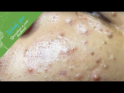 Видео: (Лечение акне для Huy, часть 1) — Расслабьтесь с Windy Spa 6#205