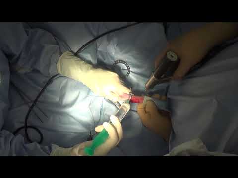 Видео: Атродез заплюсне-плюсневого сустава у кошки