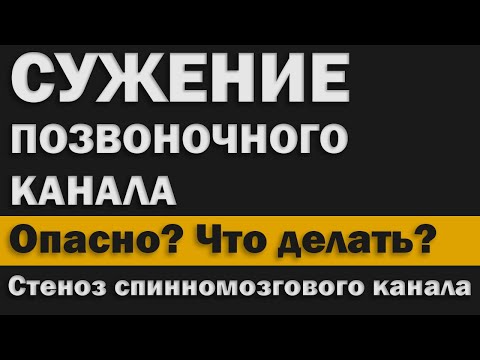 Видео: Стеноз спинномозгового канала. Опасно? Что делать?