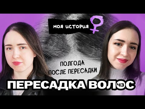 Видео: Полгода после пересадки волос. Результаты. Честный отзыв. (Женская пересадка волос при АГА)