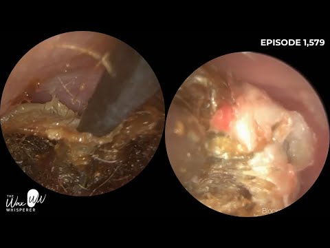 Видео: 1,579 - Сложное удаление омертвевших кожных пробок, вызванных грибком