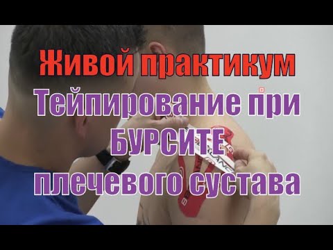 Видео: Тейпирование при бурсите плечевого сустава и сопутствующей боли