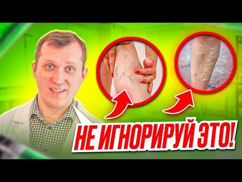 Видео: Появилась вена на ноге, это варикоз или нет?