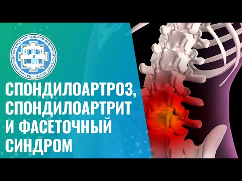 Видео: ✍️ Спондилоартроз, спондилоартрит и фасеточный синдром