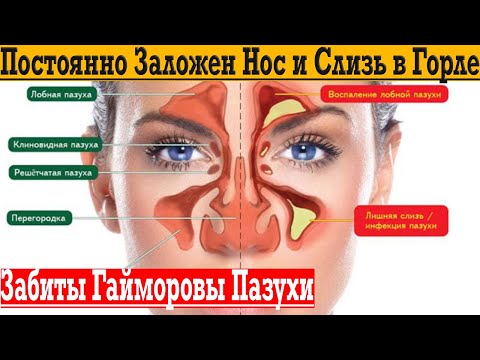 Видео: Почему постоянно заложен нос и слизь в горле, гайморит!