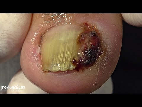 Видео: ПАЦИЕНТ ДИАБЕТИК!!