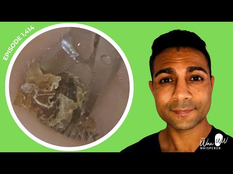 Видео: 1,414 - Удаление кератина с омертвевшей кожи при сильном зуде | Читать ответ BSHAA