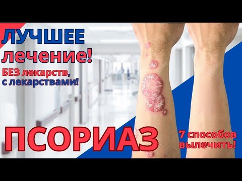 Видео: Вы 100% не знаете, все методы лечения псориаза.