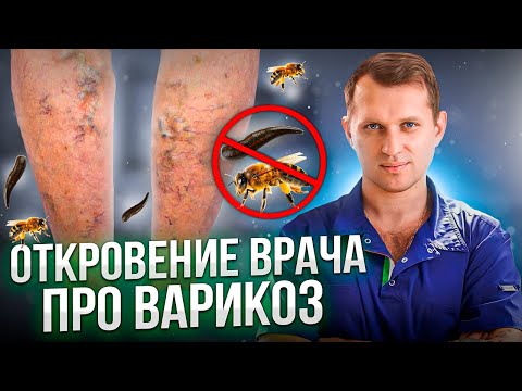 Видео: Как правильно ЛЕЧИТЬ ВАРИКОЗ? Честный ответ ФЛЕБОЛОГА!