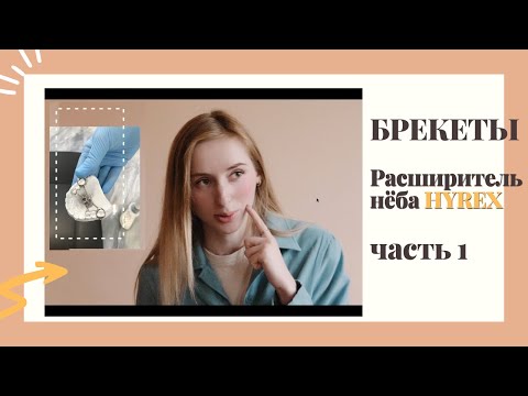Видео: БРЕКЕТЫ во второй раз, расширитель неба Hyrex, боль, дикция