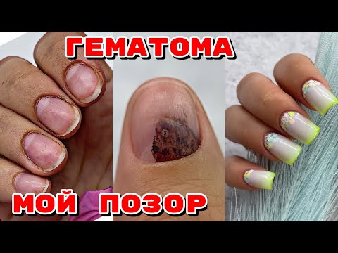 Видео: ГЕМАТОМА НА НОГТЕ 😥 СДЕЛАЛА ДЫРКУ 😐 Наращивание гелевыми типсами 💅 Маникюр на себе