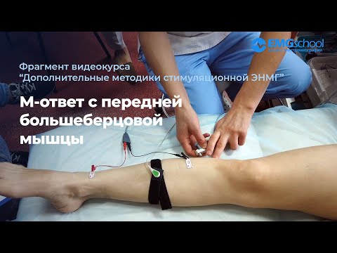 Видео: М-ответ с передней большеберцовой мышцы. Фрагмент видеокурса по ЭНМГ