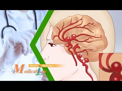 Видео: Аневризма артерий головного мозга. Причины. Симптомы. Лечение.