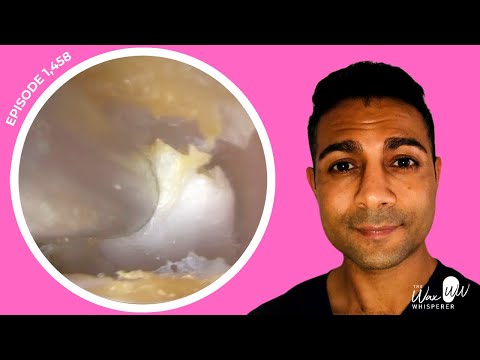 Видео: 1458 — Гранулярный мирингит выявлен после удаления липкой омертвевшей кожи с барабанной перепонки