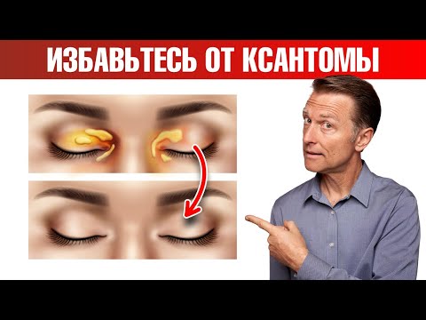 Видео: Как избавиться от ксантомы век в домашних условиях?