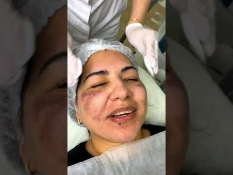 Видео: ФОТОТЕРАПИЯ КОЖИ ЛИЦА И УДАЛЕНИЕ ПИГМЕНТАЦИИ НА АППАРАТЕ М22