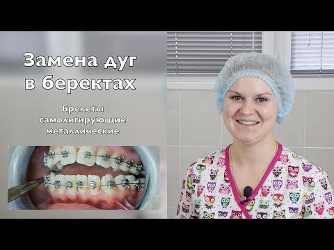 Видео: Как заменить дуги в самолигирующих брекетах. Брекеты Самара влог,  braces update