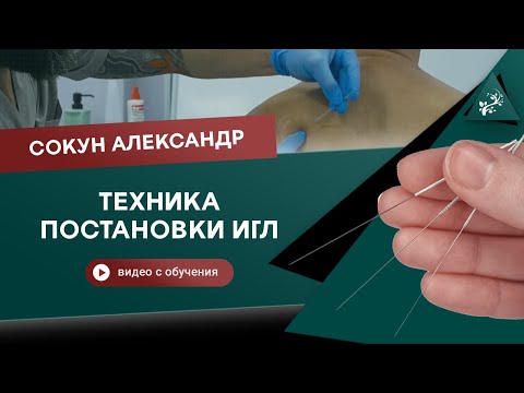 Видео: Как ставить иглы? Акупунктура. Метод сухой иглы. Сокун Александр