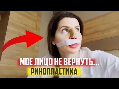Видео: РИНОПЛАСТИКА. НОС МЕЧТЫ или разочарование?