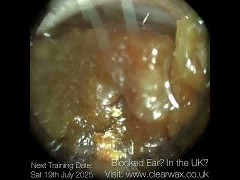 Видео: 328 тонн ушной серы удалено с помощью WAXscope®️