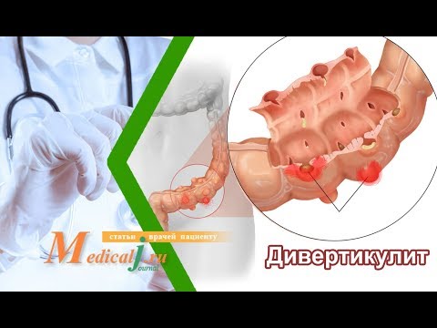 Видео: Дивертикулез и дивертикулит кишечника. Причины, симптомы, диагностика и лечение