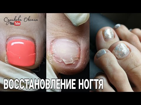 Видео: Трещина - ремонт, восстановление ногтя на ноге полигелем. Дизайн ногтей с фольгой и наклейками