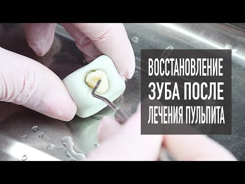 Видео: Лечение пульпита – часть 2 | пломбирование зубов  | стоматология Cамара