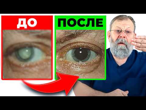Видео: Катаракта. 99% людей не знают этого 1 упражнения!