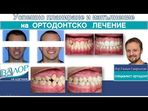 Видео: Камуфлажно лечение на трети скелетен клас с екстракции на долни премолари. #ортодонтия  #брекети