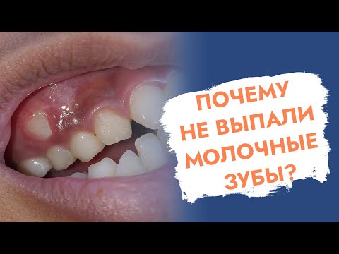 Видео: Молочные зубы. Почему не выпали у взрослого?