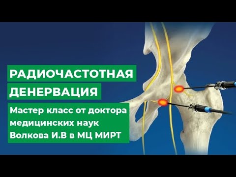 Видео: РАДИОЧАСТОТНАЯ ДЕНЕРВАЦИЯ - мастер класс  от доктора медицинских наук Волкова И.В в МЦ МИРТ