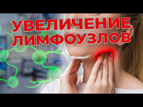 Видео: Почему увеличиваются ЛИМФОУЗЛЫ! Лимфоденопатия. Как оценить лимфоузлы самостоятельно. #лимфа #отеки