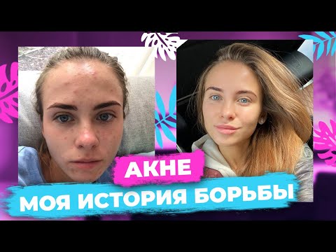Видео: КАК Я ВЫЛЕЧИЛА АКНЕ | моя история