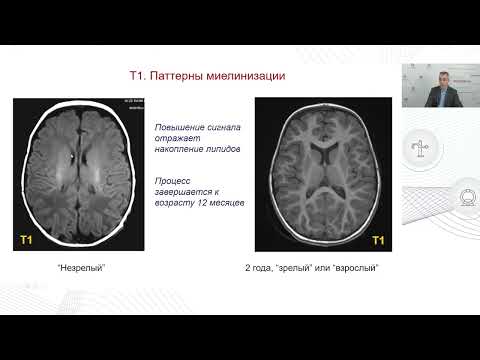 Видео: Развитие головного мозга по данным МРТ  Варианты нормы